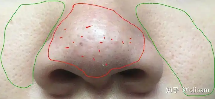 红色箭头指的毛孔里,基本上都堵塞有黑头,然后脸颊部位是毛孔粗大