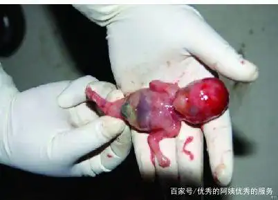 四个月胎儿怎么引产