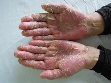 脓疱性肢端皮炎的症状和图片 - 有来医生