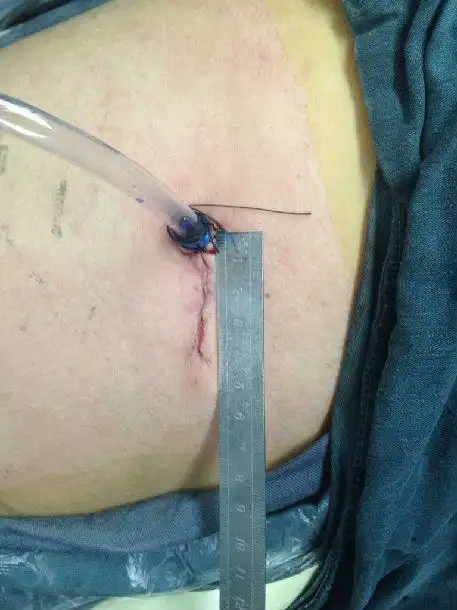 单孔胸腔镜手术切口