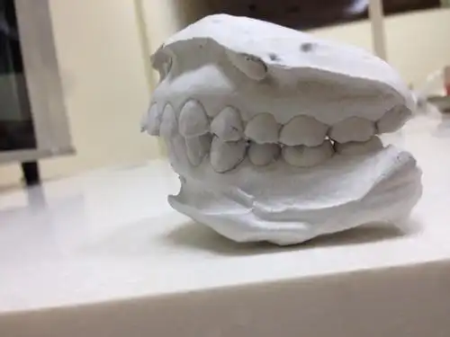 请问我这样的牙齿,需要拔掉第一双尖牙吗?