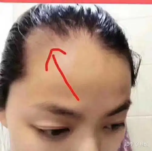 女生两边头秃怎么办?
