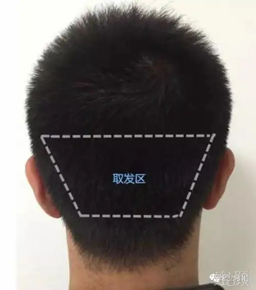 有的发友会问: 为什幺提取后枕部毛囊资源?