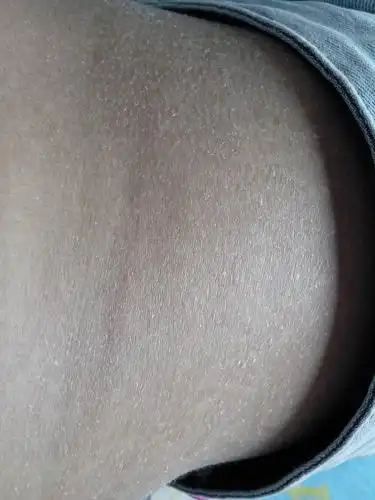 问:腰上又干燥又蜕皮怎么办?是怎么回事?