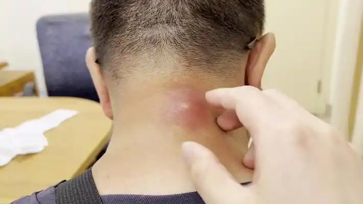 脖子上的火疖子,患者疼得无法入睡,小刀切开引流!