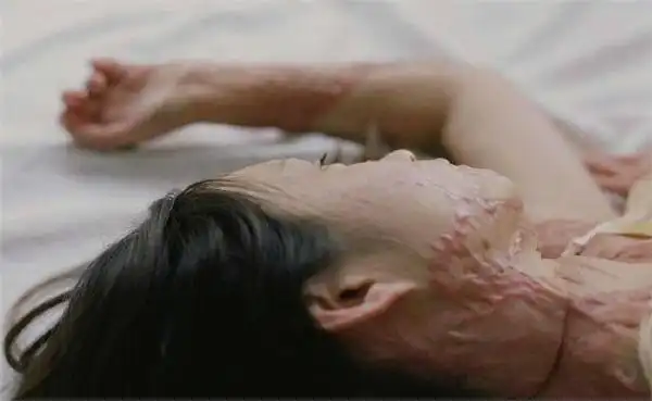 被富二代泼汽油女孩出写真伤疤仍触目惊心图