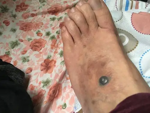 您好我脚背2006年长了个黑痣现在很担心是黑色素瘤发图片可以