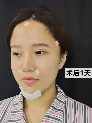 脂肪填充一个月眼睛深邃还小怎么回事