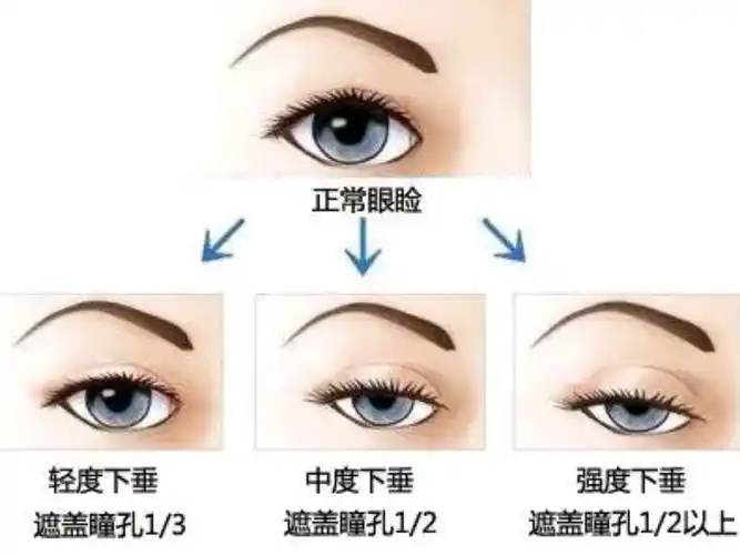 做双眼皮先测一测有没有"上睑肌无力"吧