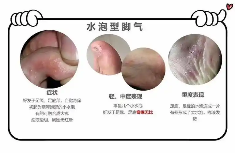 足癣分型与治疗及预防_脚气_症状表现_如何预防_治疗方式_日常注意