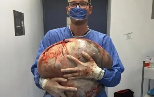 未婚女孩肚里产出64斤怪胎