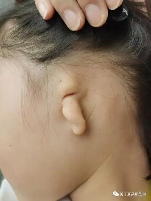 5d义耳取模和佩戴过程_小耳畸形_小耳畸形治疗方式 - 好大夫在线