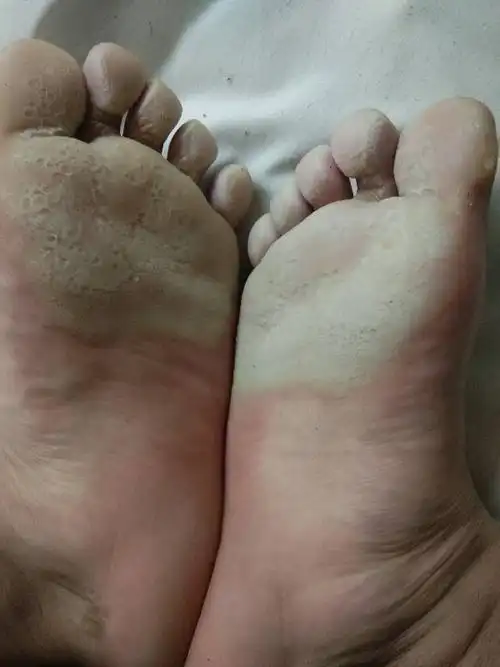 脚掌遇水变白,并且凹凸不平的,是怎么回事?怎么治呀?_百度知道