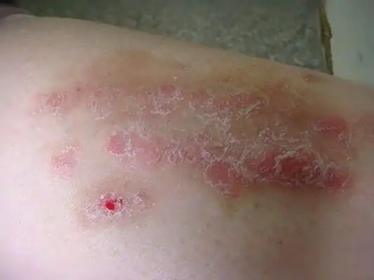 头部银皮屑的症状图片_银屑病求医网