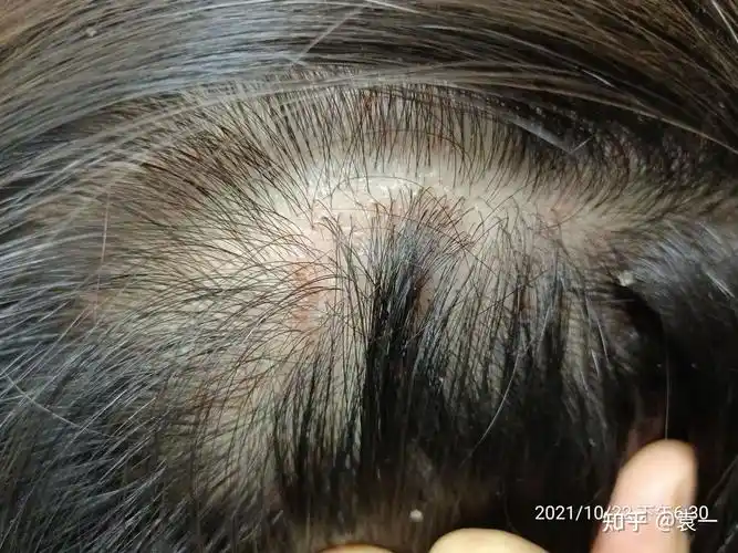 头部毛囊炎到底咋治,各位大佬! - 知乎