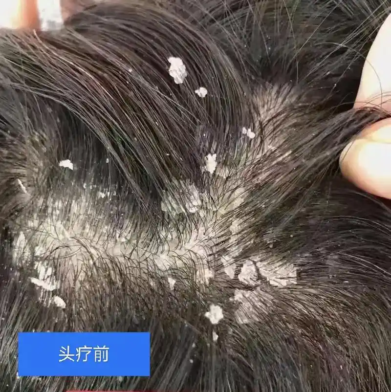 若有头油,头痒,头屑,脱发,毛囊炎症,银屑病 - 抖音
