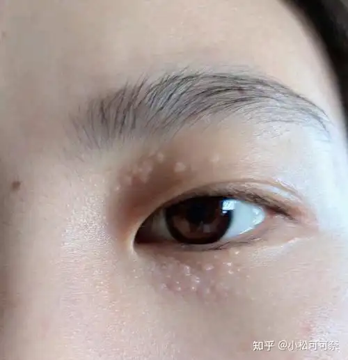 脂肪粒会自己掉吗