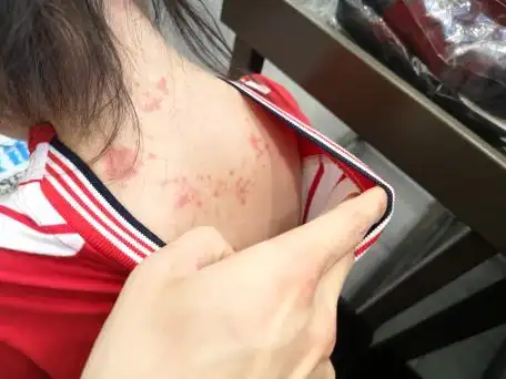 女儿五岁,这两天后背上出现这些豆子,开始以为是痱子但又很不像,请问