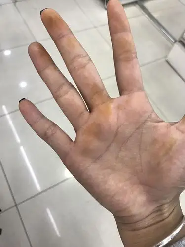 手平时好好的,今天突然黄了,怎么回事