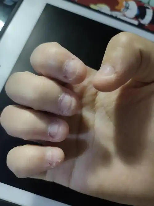 11.6更新‖慎入 本组最差指甲 啃了二十年的指甲,应该已经.