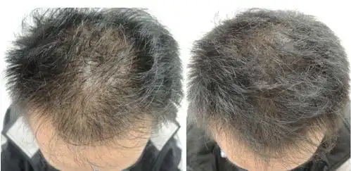 脂溢性皮炎脱发怎么治疗,生发产品哪个效果好 - 美篇