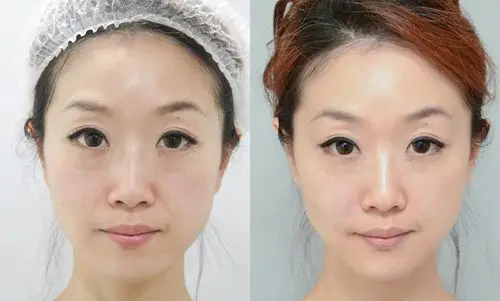 修修脸,填充拉提效果立刻看得见 - 愿丽医美诊所【ellanse洢莲丝】