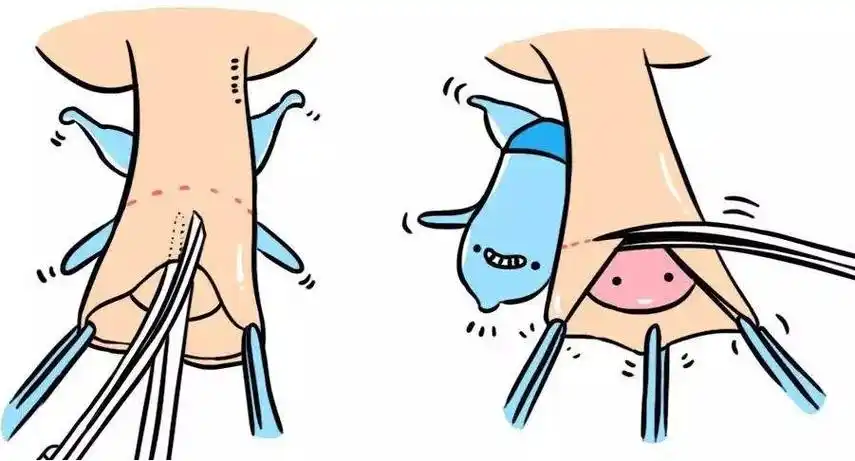 该怎么办?_手术_患者_龟头