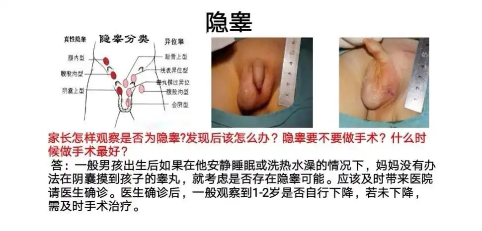 确定是否为隐睾及隐睾的位置,但如果体检没有在阴囊及腹股沟发现睾丸