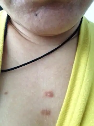 我胸口的疙瘩起好几年了,里边什么也没有!有时痒痒,现在疼.