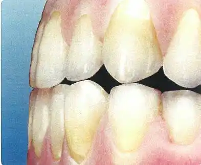 前突(前牙角度)(图3 切缘与尖牙磨损平面)步骤39舌侧解剖形态修整在桥