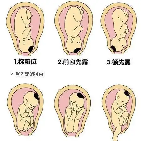 大多数胎儿在七个月的时候胎位就不再变化了,但也有一些调皮宝宝生前