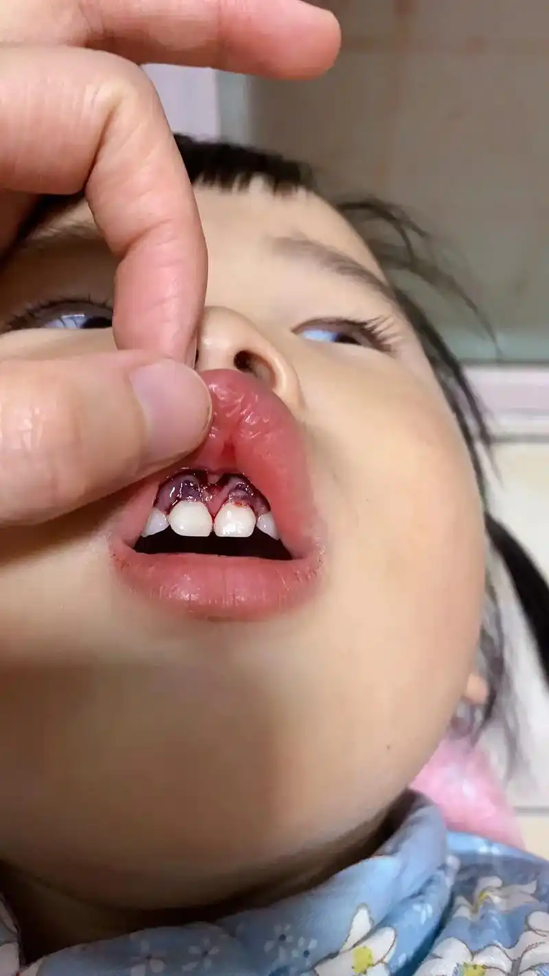 乳牙 牙齿07受伤的第五天,牙龈渗血渗了近3天,不能吃硬的 - 抖音