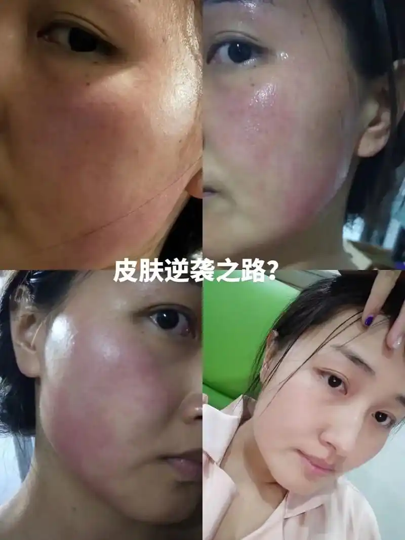 本人的皮肤逆袭之路 从之前的黄黑皮,敏感易过敏肌肤变成现在的 - 抖
