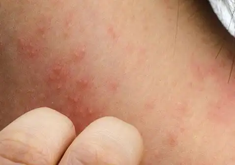 湿疹图片