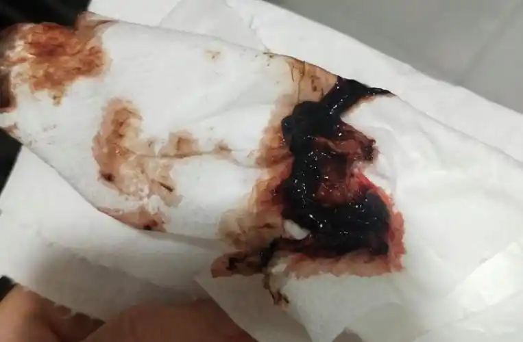 你好,一直都有排卵期出血,在两次月经中间