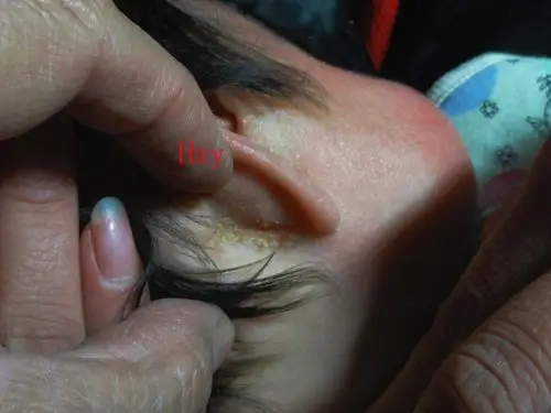 婴儿头部皮损--脂溢性皮炎