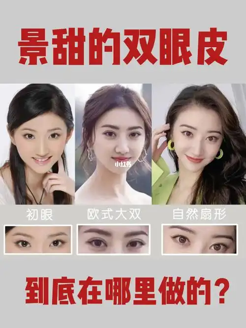 看景甜双眼皮修复前后的对比