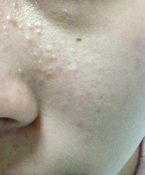 其他地方的皮肤都蛮好的 就鼻翼两侧有这种痘 是闭口吗 该怎么消阿