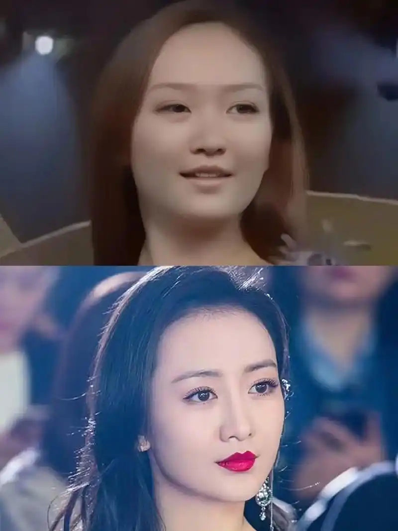 瘦了咬肌加和增加下巴比例之后,整个脸型更加瘦窄.