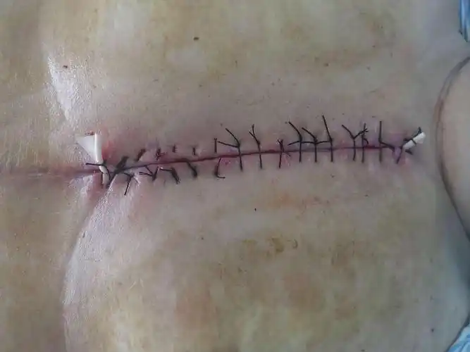 一例开胸术后切口不愈合的治疗