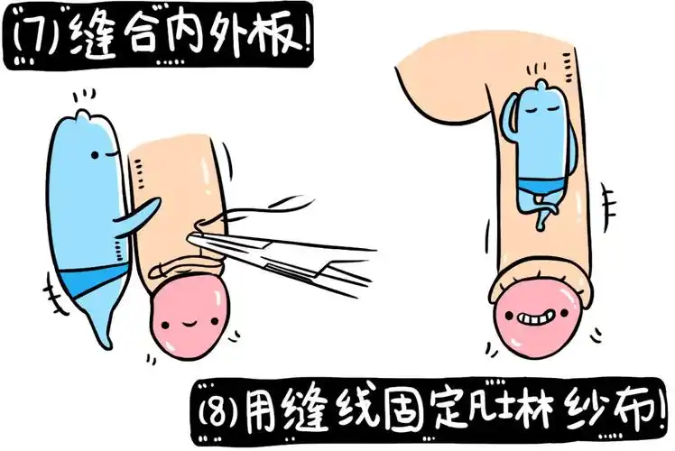 清洗消毒:用肥皂水和盐水清洗局部,用1:1000新洁尔灭液消毒;包茎者以