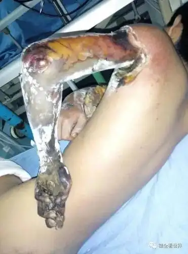 由于高压电的烧伤,他的左手已经被截肢,左手手臂都没有了.