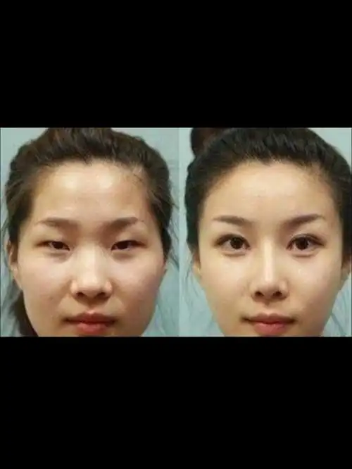 双眼皮和单眼皮有什么区别,从美学角度讲,双眼皮_圈子-新氧美容整形