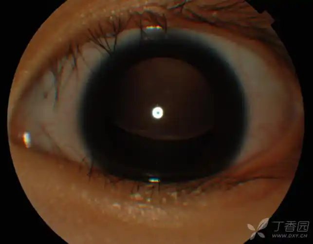 儿童马凡综合征双眼晶状体半脱位 [病例帖]