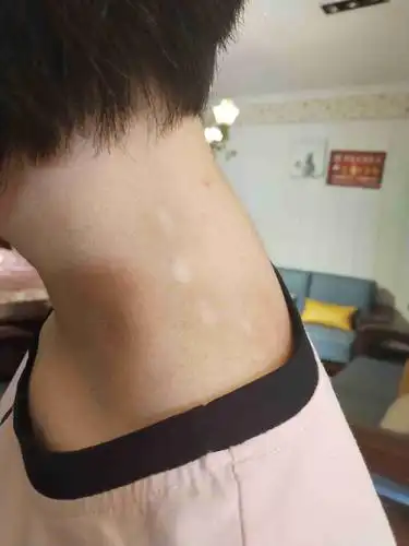 这是什么?白斑吗?