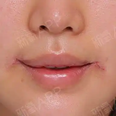 【唇部整形】【嘴角上提术】韩国【zn整形外科】名牌_圈子-新氧美容
