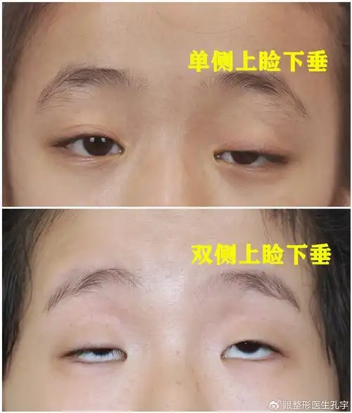 重症肌无力上睑下垂如何治疗?检查,诊断,制定方案,术后护理.