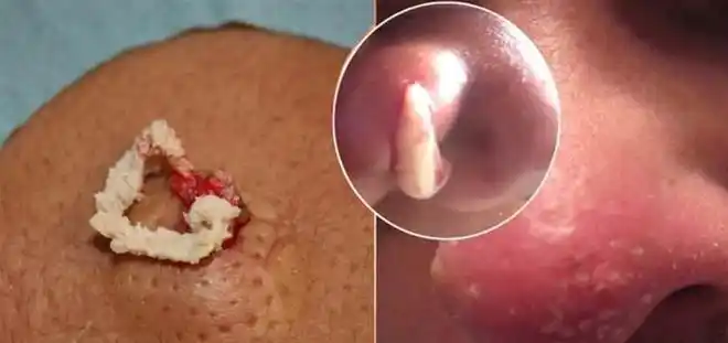 的分泌物,大量的油脂就会分泌过多造成皮脂腺中释放大量游离的脂肪酸