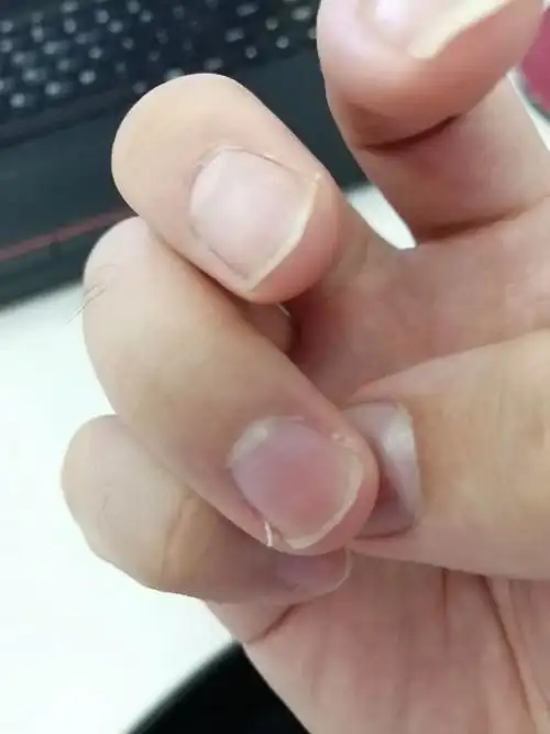 指甲长了侧边分出来的小细条是怎么回事