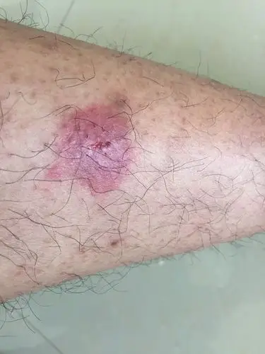 问医生 浏览官网  展开全部 你好这个情况来看,初步判断是毛囊炎导致